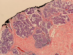 ILC with extensive LCIS