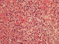 Virilizing hilus cell tumor of the ovary
