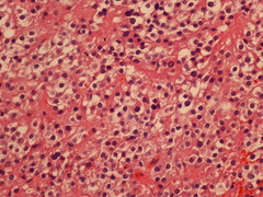 Virilizing hilus cell tumor of the ovary